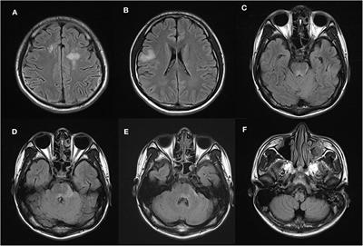 Value of Area Postrema Syndrome in Differentiating Adults With AQP4 vs. MOG Antibodies